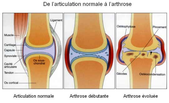 schema-articulation-et-arthrose.jpg