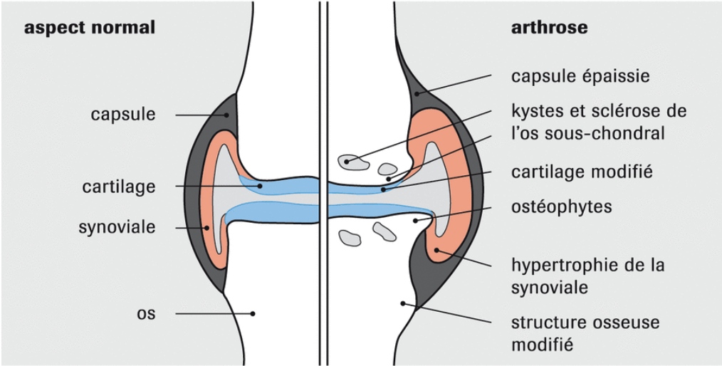 Schéma d’une articulation sans/avec arthrose :